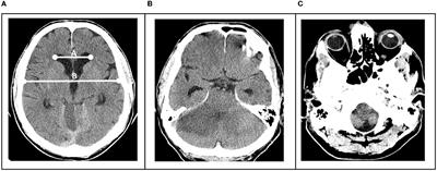 Predictors of clinical outcomes in space-occupying cerebellar infarction undergoing suboccipital decompressive craniectomy